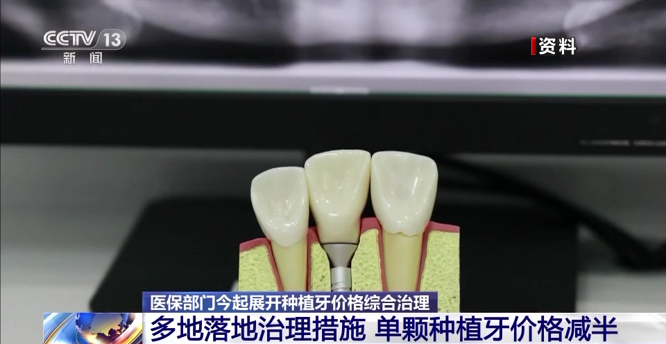 医保部门今起展开种植牙价格综合治理 单颗种植牙价格减半