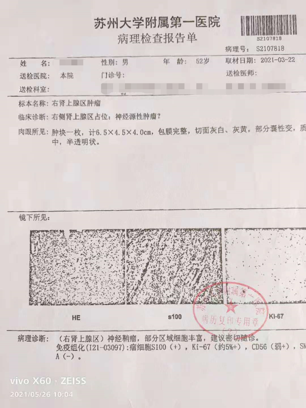 患者花5万切瘤后不理赔 太平洋保险:良性肿瘤不在保障范围 患者花5万切瘤后不理赔 太平洋保险:良性肿瘤不在保障范围